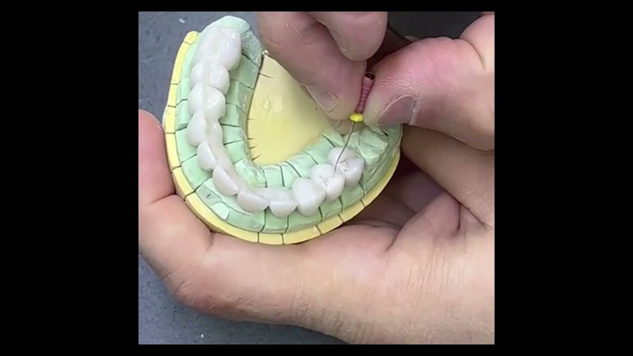 Full Contour Zirconia Bridge BL3 Staining And Glazing