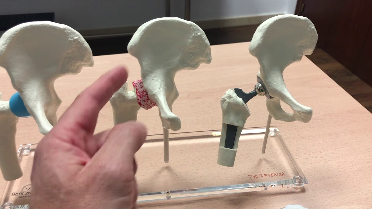 PROTESIS CADERA   DR REVENGA