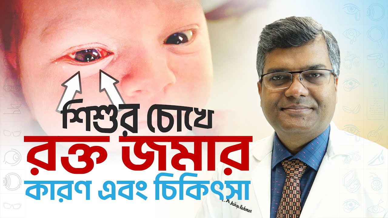 শিশুদের চোখে রক্ত জমার কারণ, লক্ষণ এবং চিকিৎসা II @𝗗𝚛. 𝗔𝚜𝚑𝚒𝚚𝚞𝚛 𝗥𝚊𝚑𝚖𝚊𝚗 𝗔𝚔𝚊𝚗𝚍𝚊
