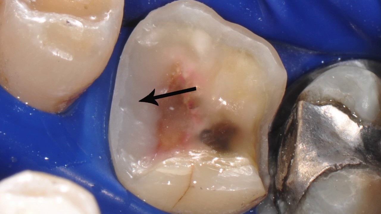 Semi Direct Composite Technique