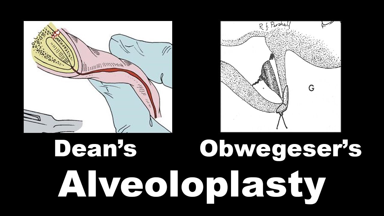 Dean's Alveoloplasty & Obwegeser Alveoloplasty