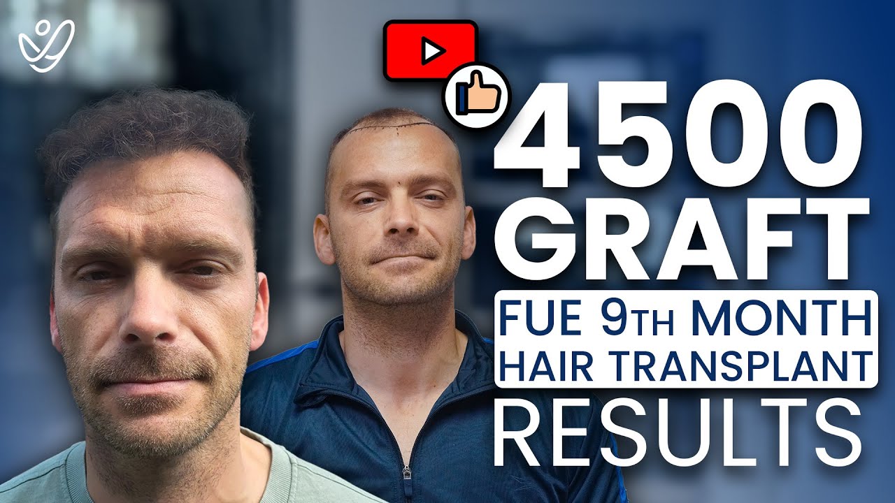 4500 Graft FUE Hair Transplant The Unexpected 9 Month Result!