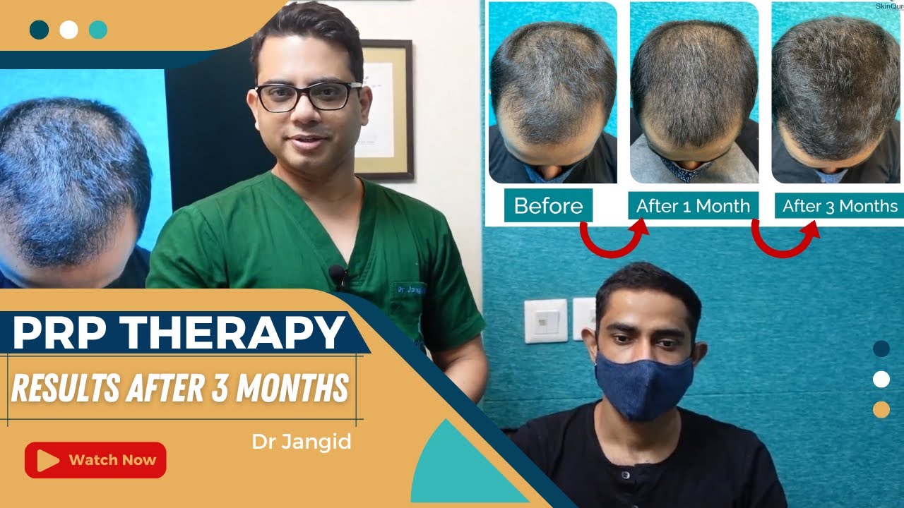 PRP Therapy Results After 3 Months | Hair Transplant by Experts in Delhi | Dr Jangid