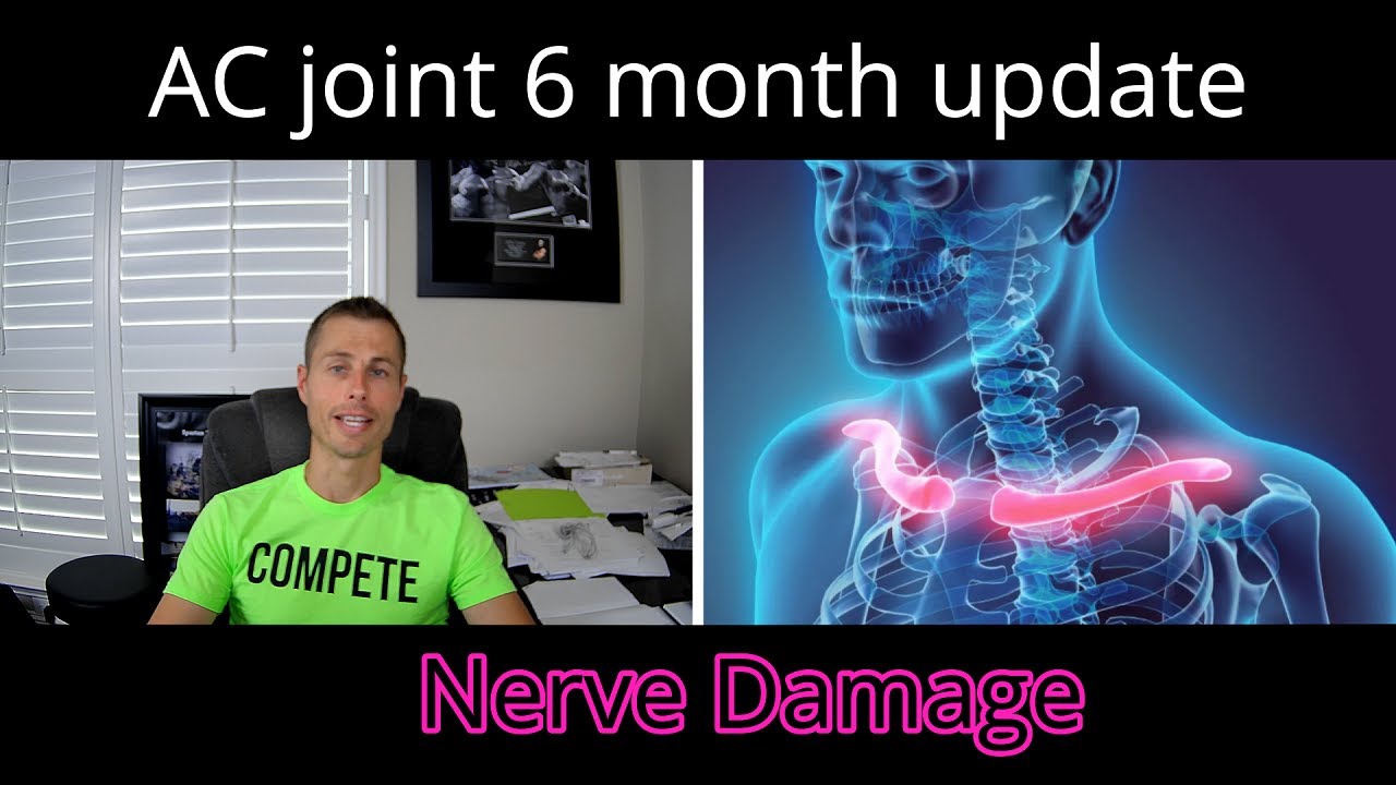 AC joint surgery 6 month update | Nerve damage from distal clavicle resection surgery