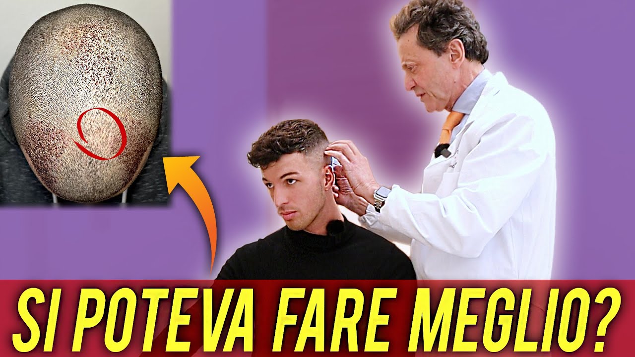 CHIRURGO VALUTA IL MIO TRAPIANTO DI CAPELLI A 11 MESI DALL'OPERAZIONE