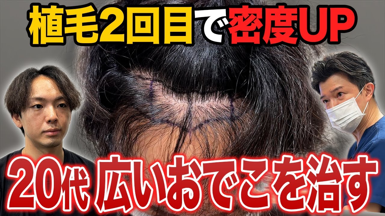 【総額330万円】広いおでこに悩み続けて決死の思いで2回目の植毛に挑戦！