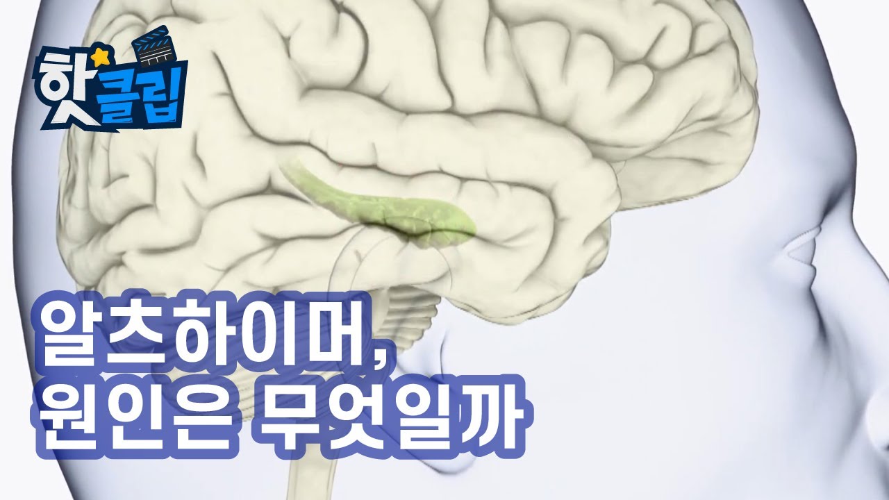 알츠하이머의 원인은 무엇일까? [핫클립] / YTN 사이언스