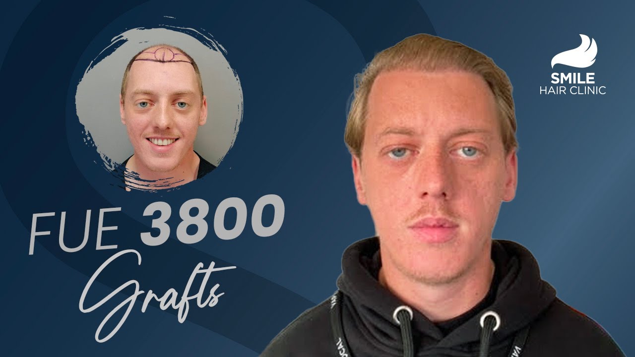 12 Months Later: 3800 Grafts Hair Transplant | Smile Clinic