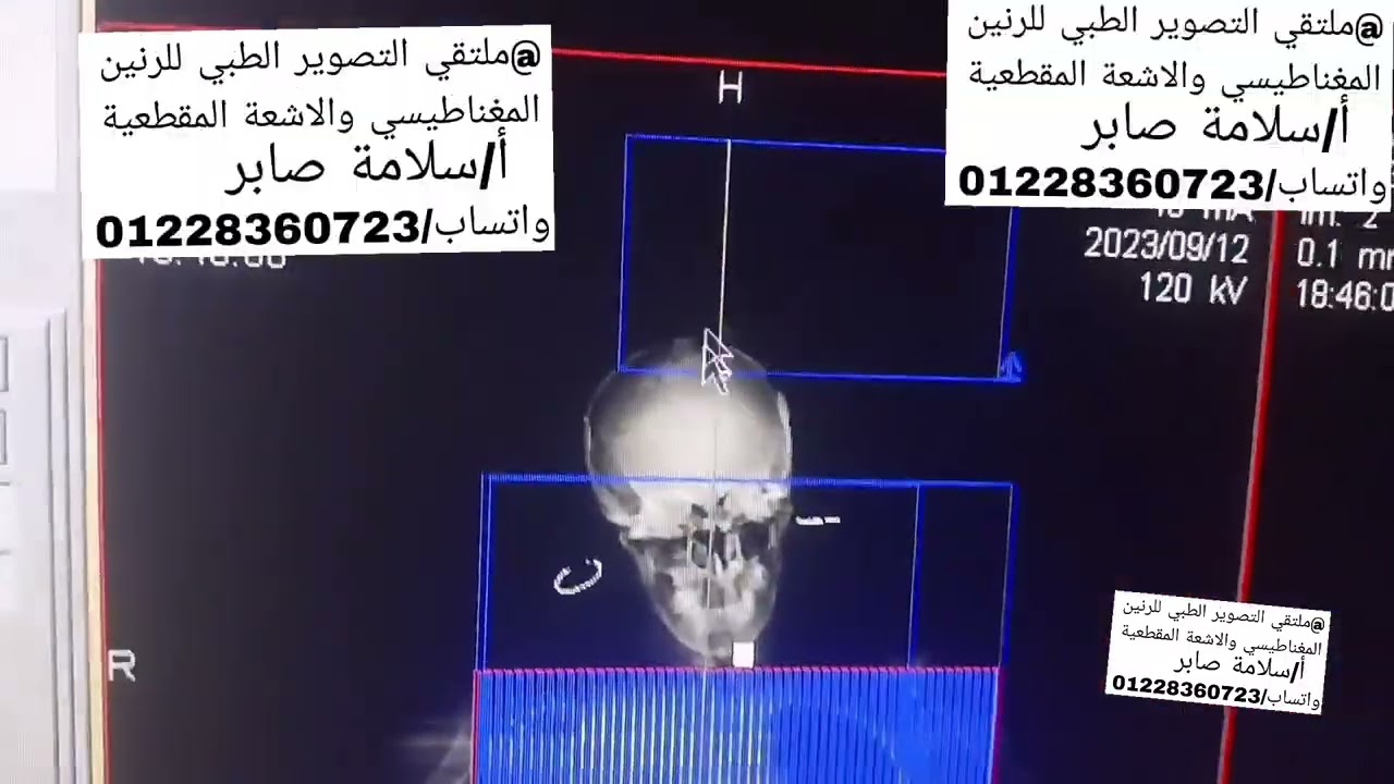 مقطعيه علي الصدر والرقيه والمخ بحقنه واحده وتصوير واحد  #CT_CHEST_NECK_BRAIN