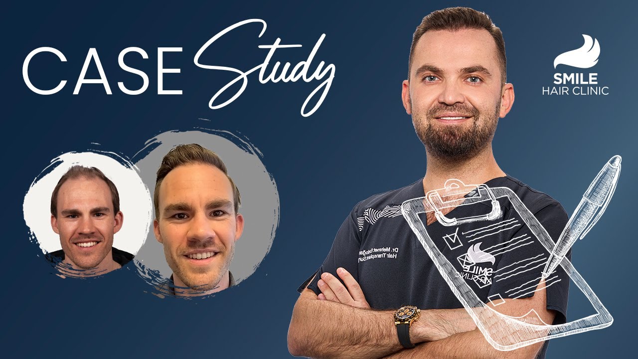 Epic Hair Transformation: 6700 Grafts Case Study with Dr. Mehmet Erdogan - Hair Transplant