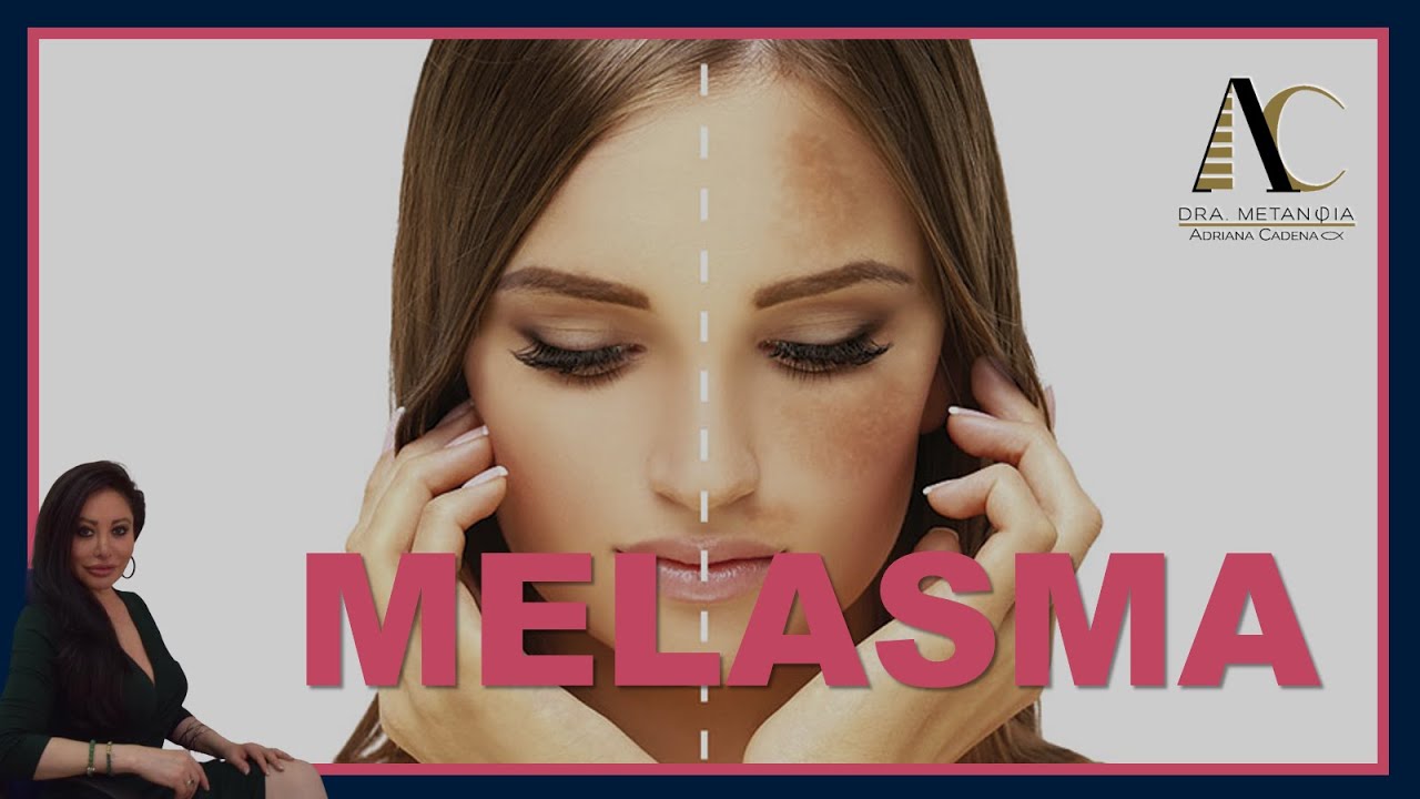 Melasma y su significado biológico emocional para tratarlo