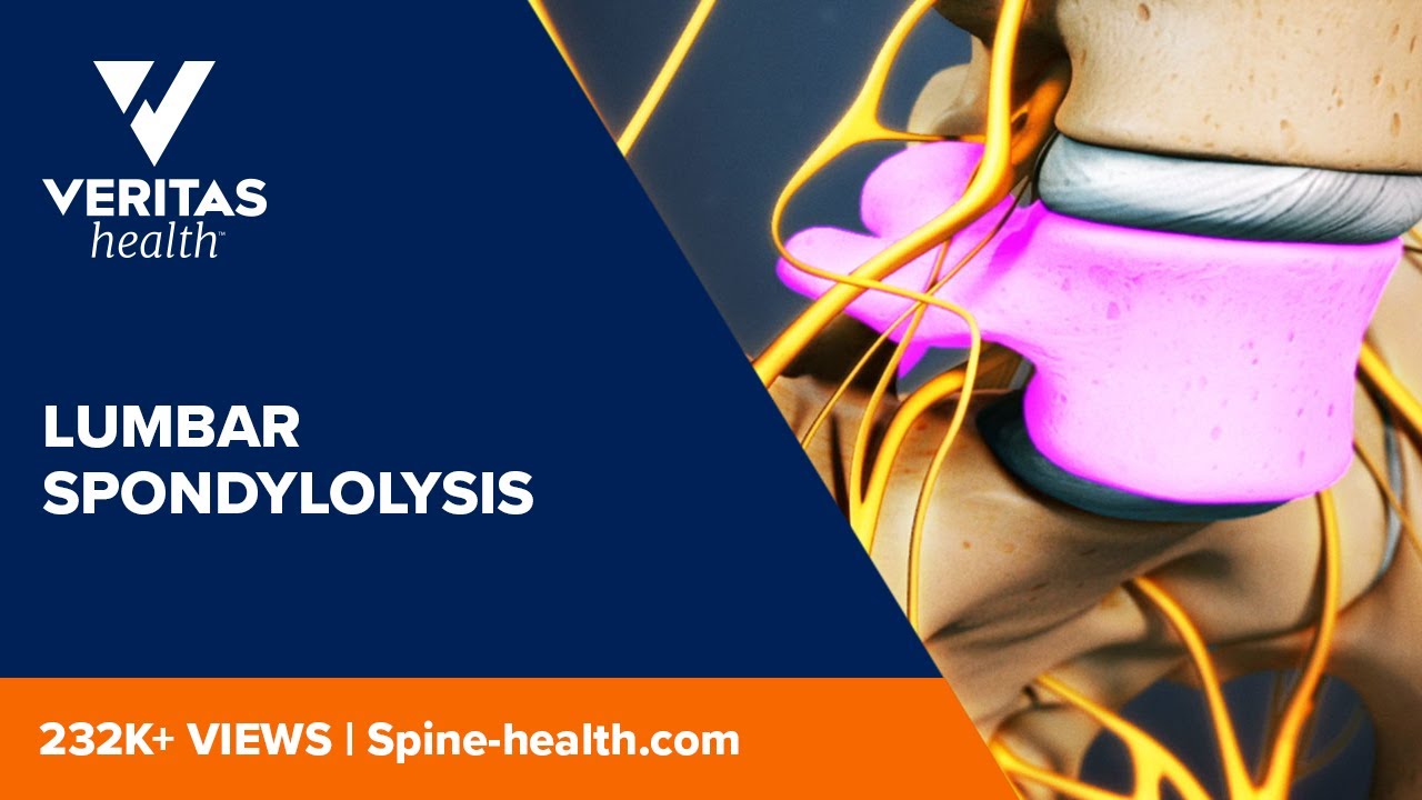 Lumbar Spondylolysis