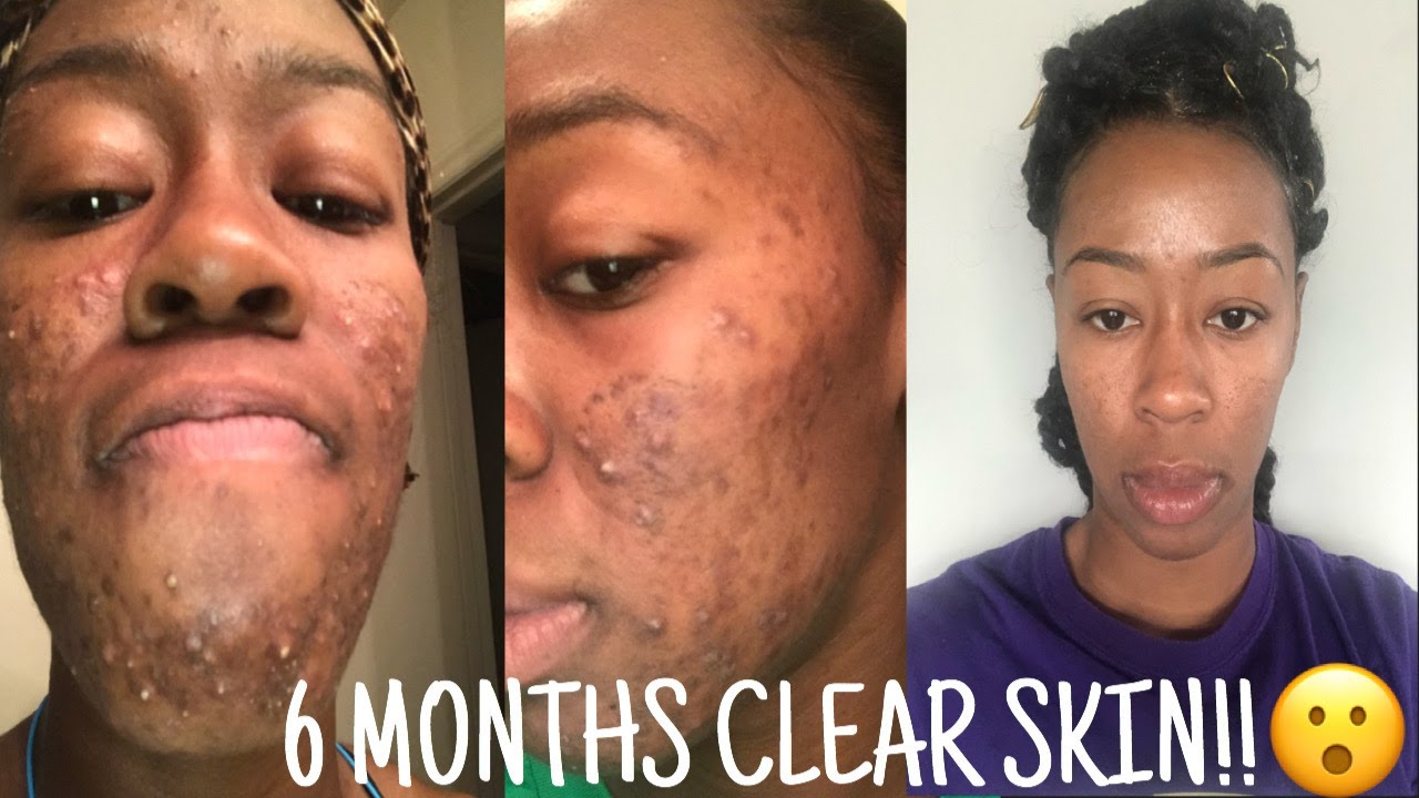 10 YEARS OF ACNE GONE!│ACNE TREATMENT