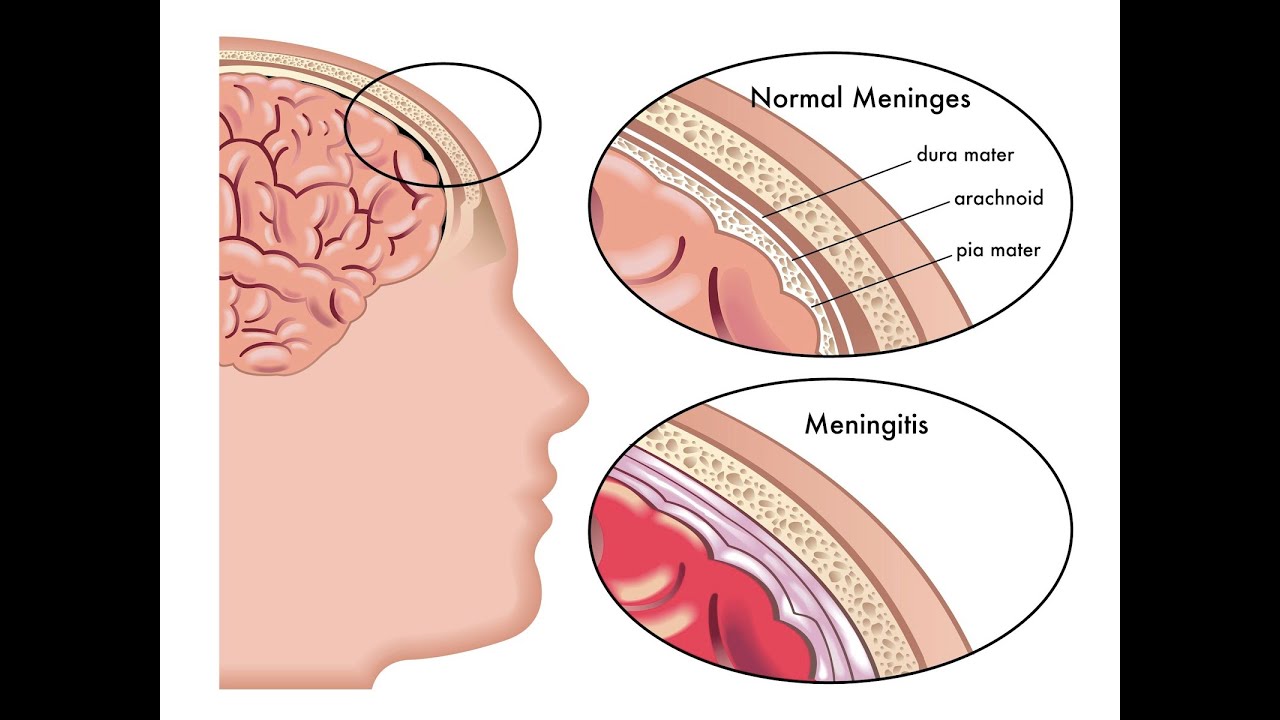 Meningitis