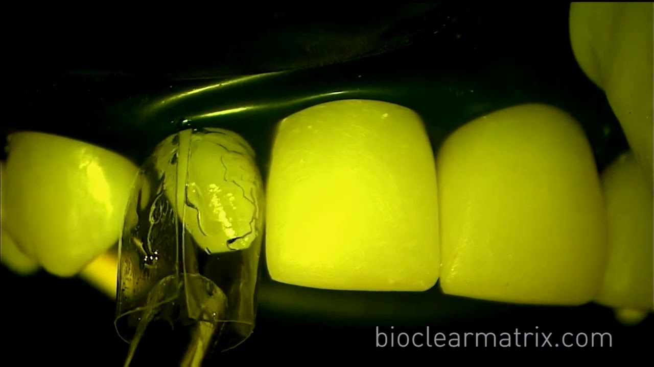 Bioclear Composite Veneers for Undersized Teeth  Part 2