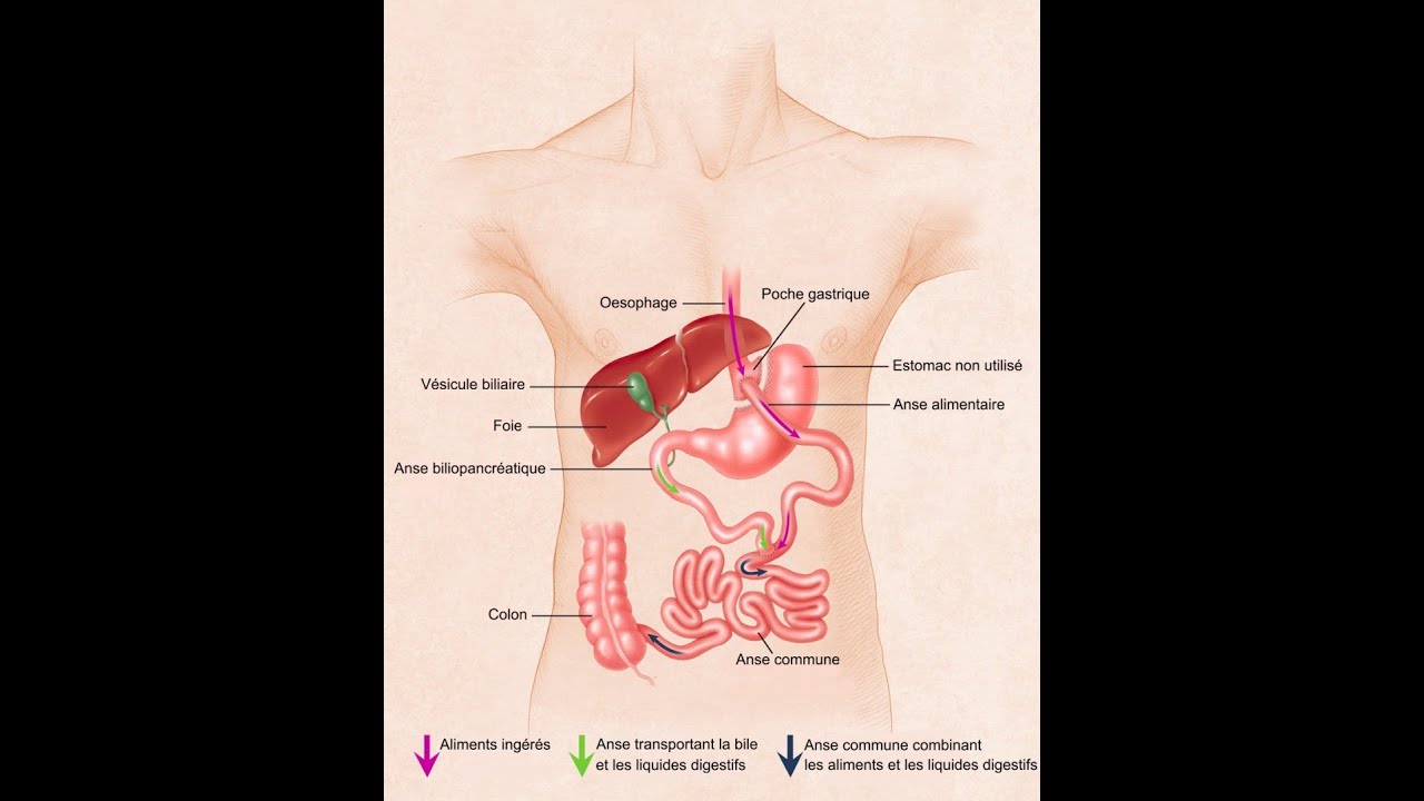 Chirurgie bariatrique - Le Roux-en-Y (Bypass)
