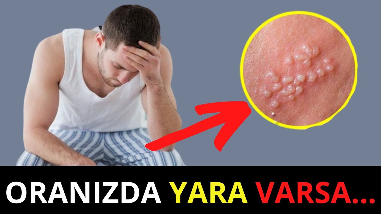 Oranızda Yaranan Yara bu Xəstəlikdən Xəbər Verir - GENİTAL HERPES