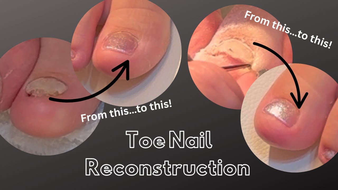 Double toenail reconstruction with NanoFlex by Fuzion Gel