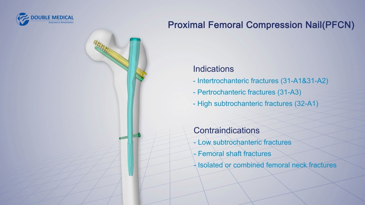 Double Medical Proximal Femoral Compression Nail ( PFCN )