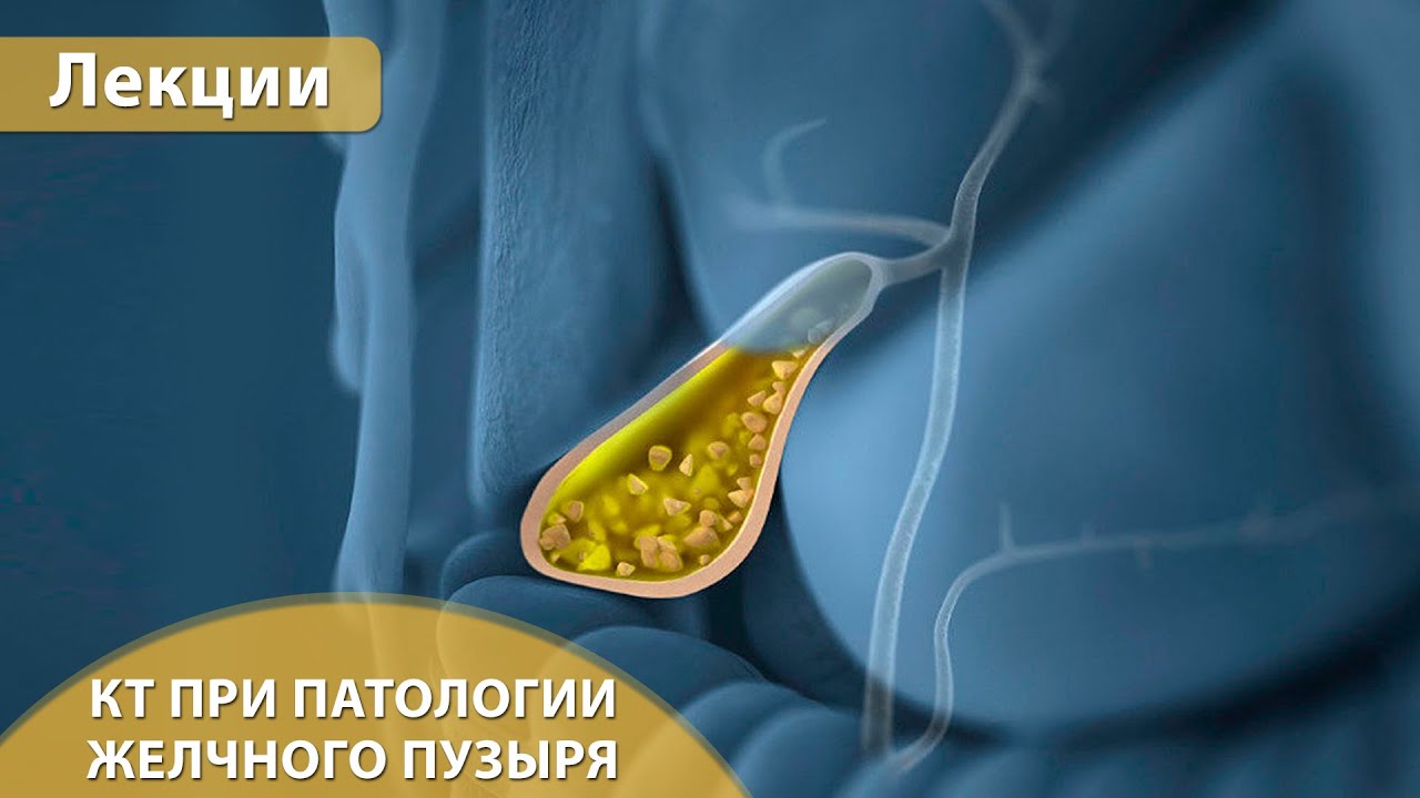 Компьютерная томография при патологии желчного пузыря. Андрей Мангов