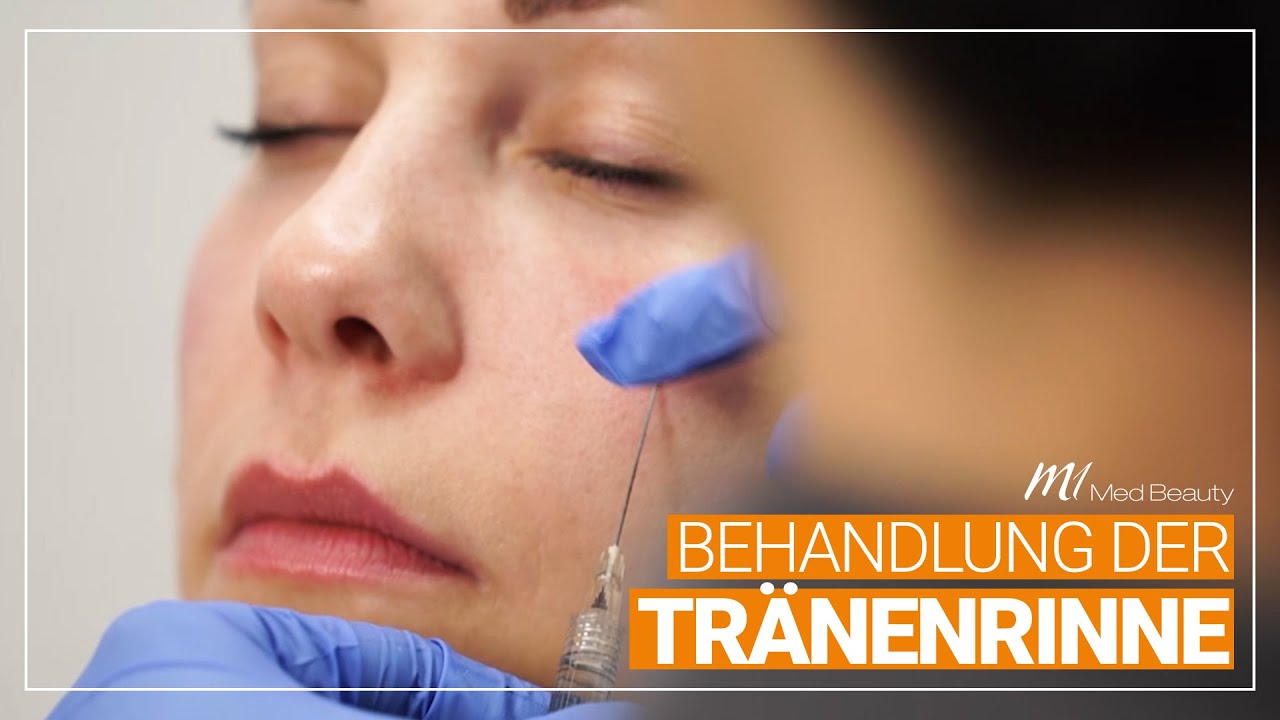 Behandlung der Tr&auml;nenrinne | M1 Med Beauty