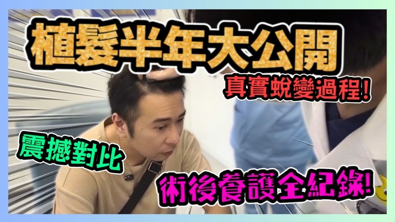 植髮半年大公開 術後養護全紀錄💇‍♂️！從稀疏到濃密 震撼對比🌟！大麥植髮 粉絲專屬福利🛎️！