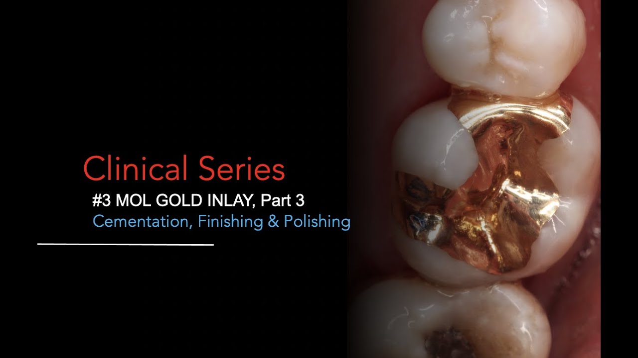 Gold Inlay Restoration, Part 3: Cementation, Finishing, and Polishing