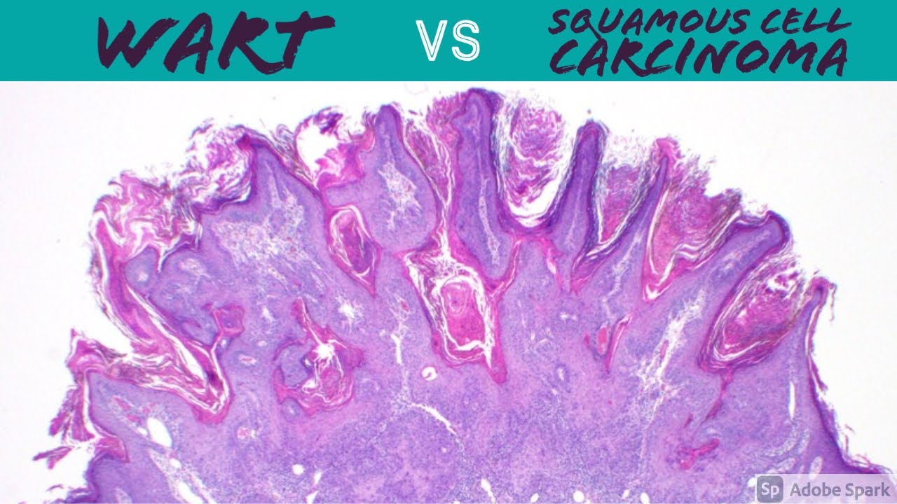 Wart vs Squamous Cell Carcinoma (Dermpath Pathology Dermatology Verruca Seborrheic Keratosis SCC)
