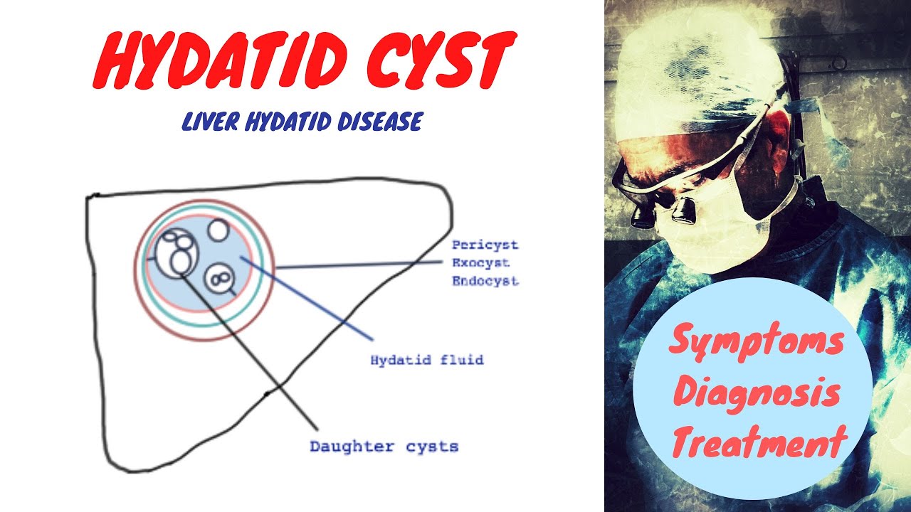 Hydatid Cyst