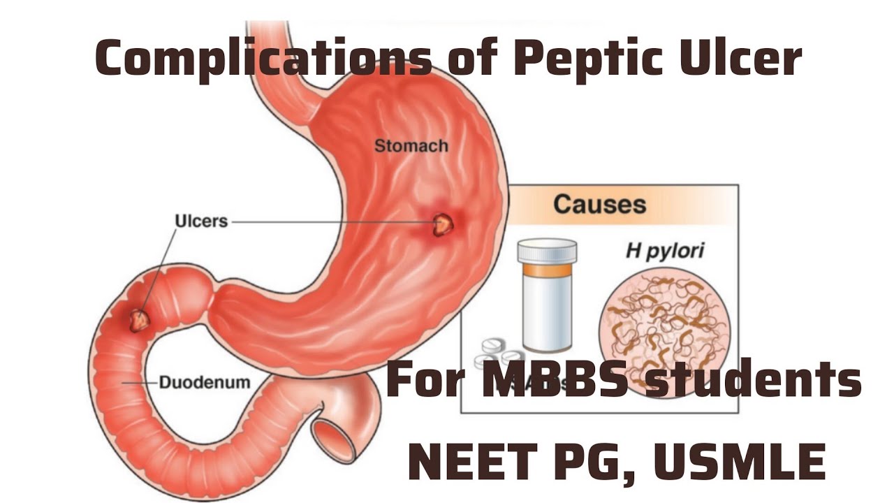Complications of Peptic Ulcer For MBBS students, Neet PG, Usmle I Neet Usmle Preparation