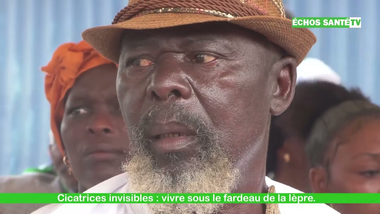 Cicatrices invisibles : vivre sous le fardeau de la lèpre.