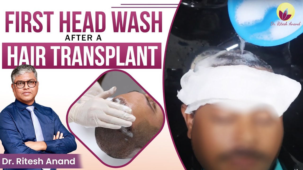 First Head Wash After Getting Your Hair Transplant in Gurgaon | Shampoo, Hair Wash & Care Tips