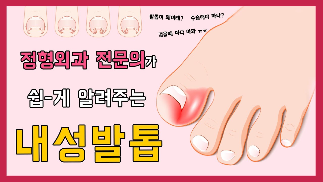 살을 파고드는 내성 발톱!! 어떻게 관리해야 하나요?