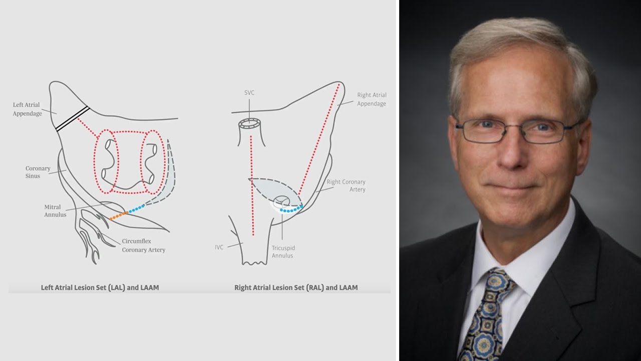 Glenn Barnhart, MD – The Cox-Maze IV and Surgical Ablation Evolution