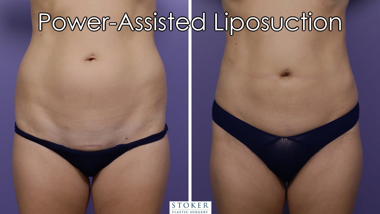 Liposuction Los Angeles: Plastic Surgeon Dr. Stoker Demonstrates 360 Liposuction & Breast Lift