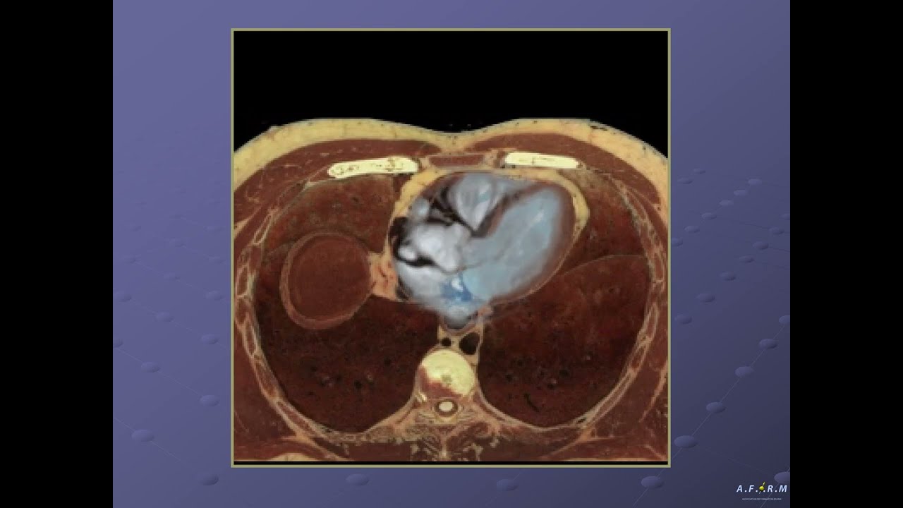 IRM cardiaque
