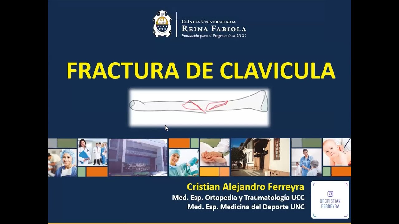 FRACTURAS DE CLAVICULA   DR FERREYRA