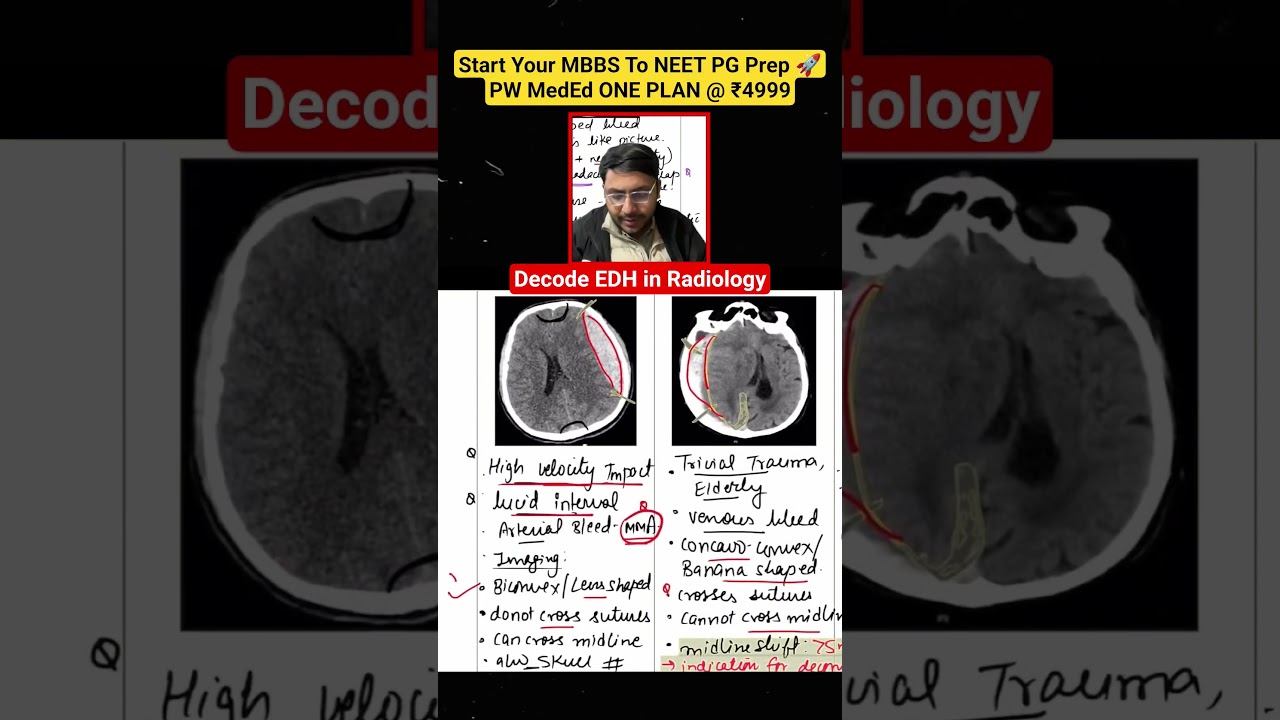 FMGE / NEET PG High Yield: MMA & Lucid Interval Explained 📉 