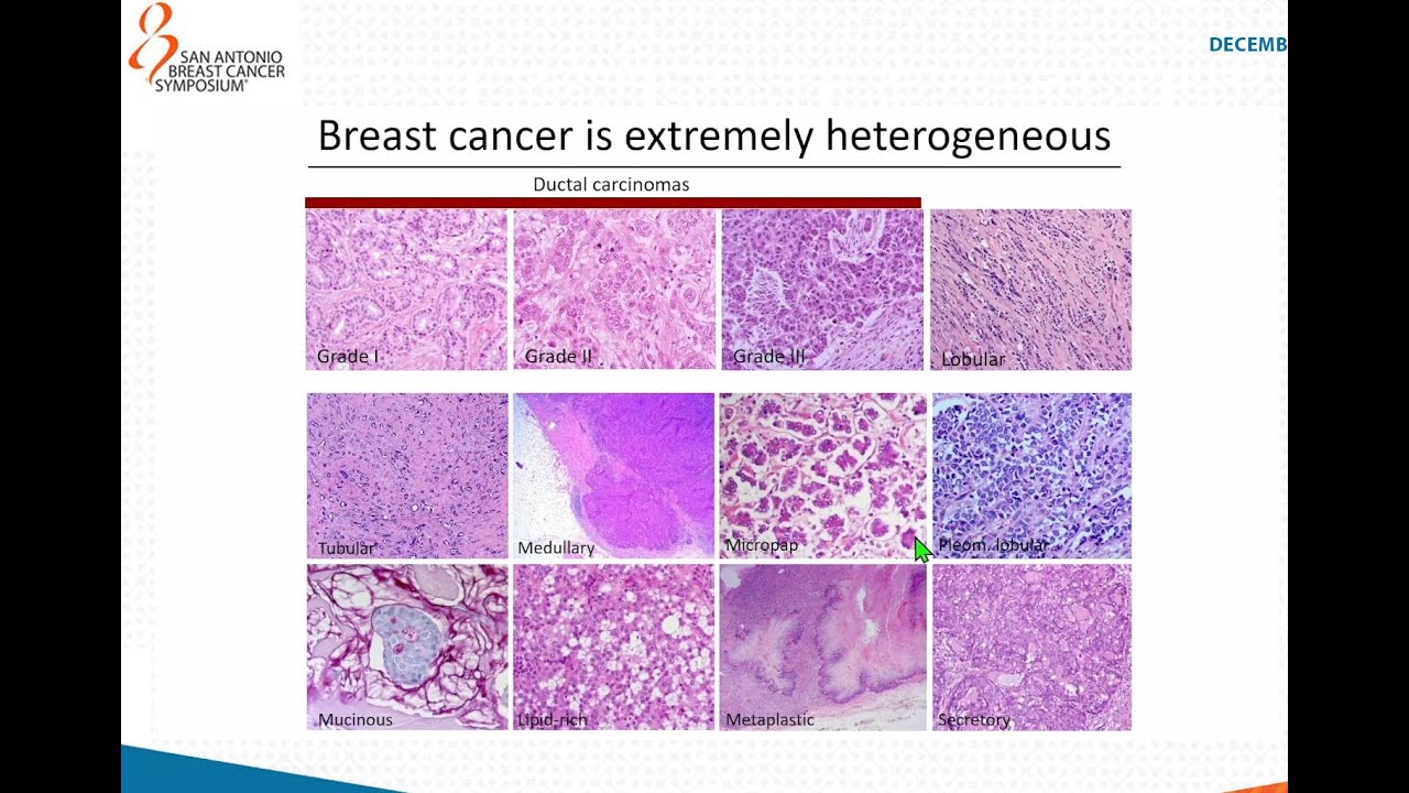 SABCS 2024: Tumor heterogeneity and evolution