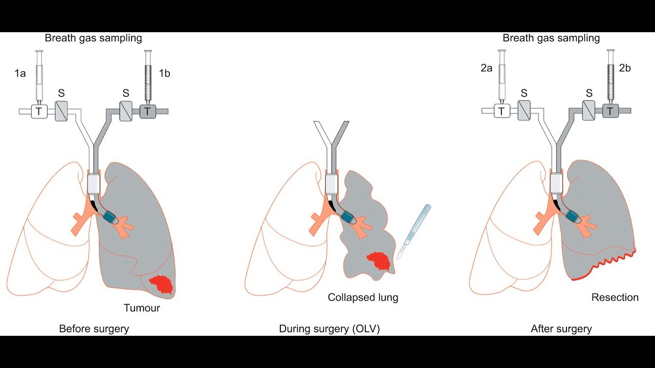 One lung ventilation