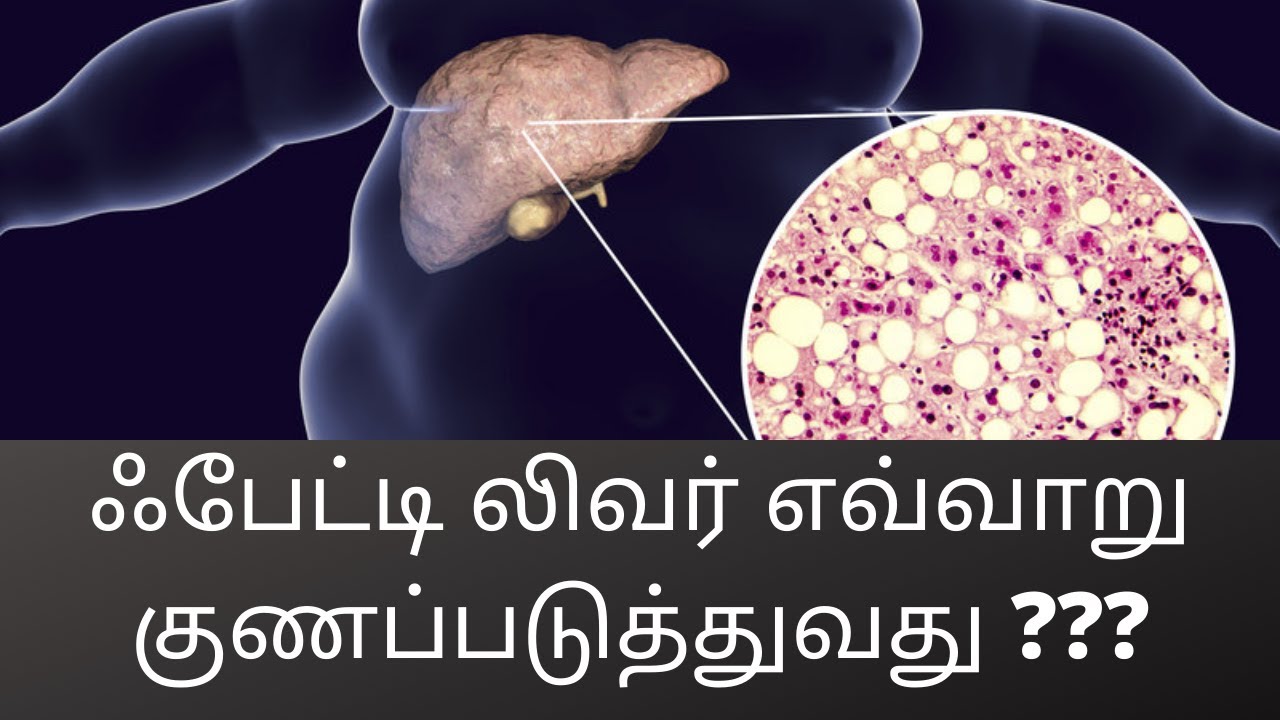 கொழுப்பு கல்லீரலைக் குணப்படுத்துவது எப்படி / How to cure fatty liver / C K Nandagopalan