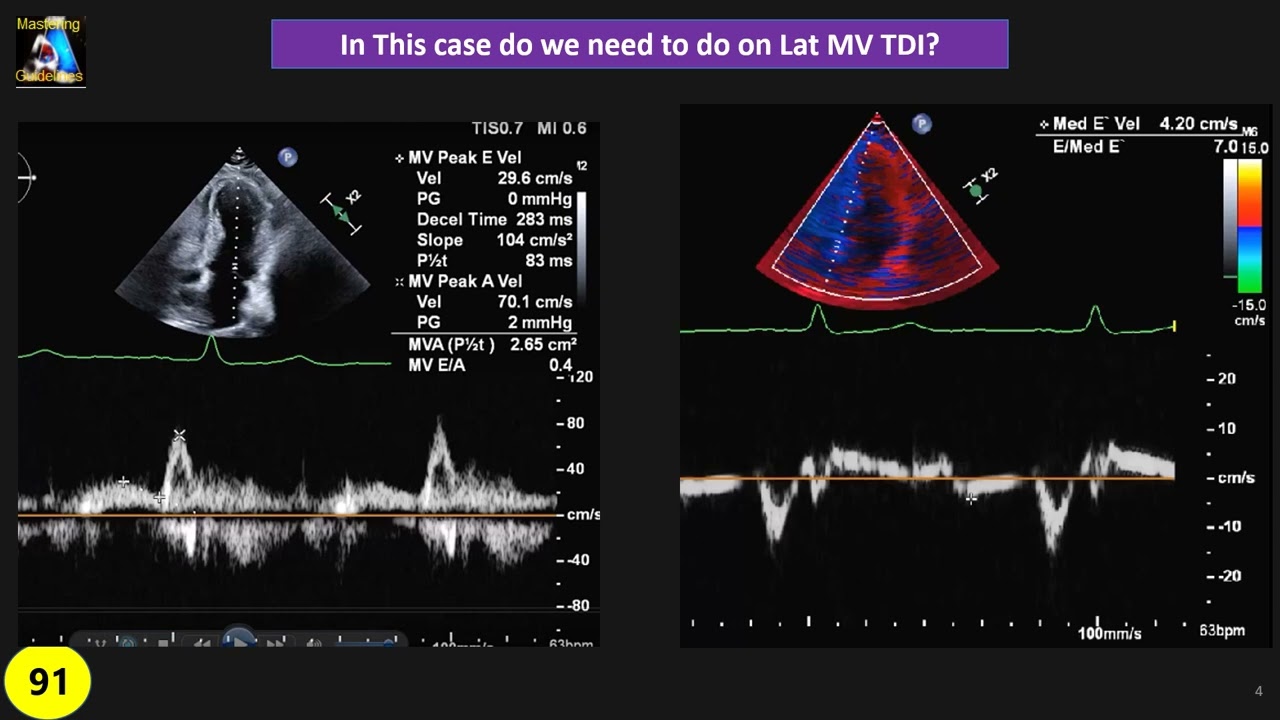 case study7: myocardial infarction complication