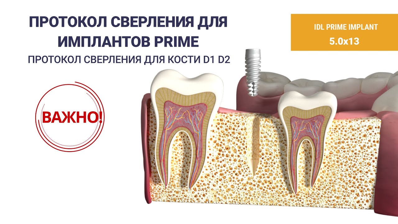IDL Implant Installation Video Tutorial (Видеоруководство по установке имплантов IDL)
