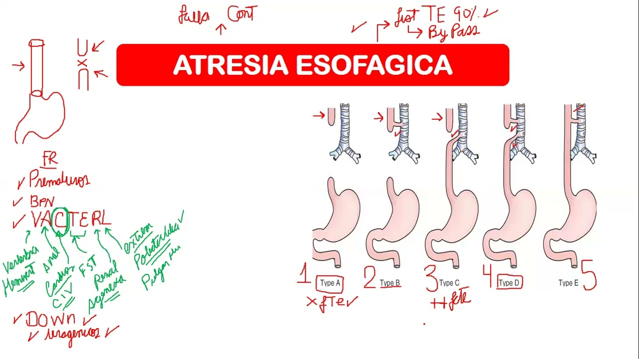 ATRESIA ESOFAGO // LAS FIJAS - QX PEDIATRICA