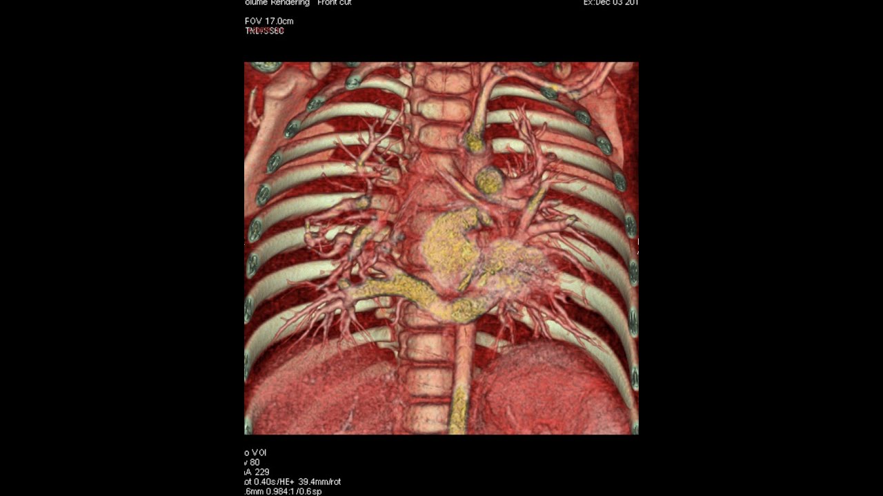 DU CPC 2021 22 M3C Necker Univ de Paris RVPA et anomalies des veines pulmonaires Neil Derridj