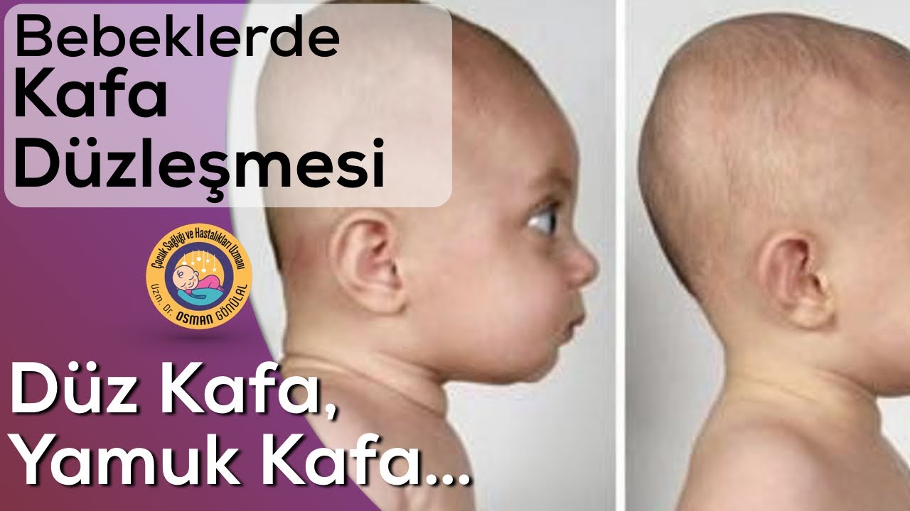 Bebeklerde Kafa Düzleşmesi ve Yamukluk (Plagiosefali)