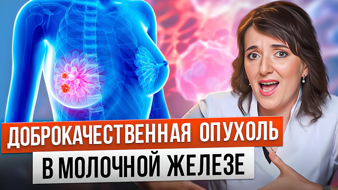 УПЛОТНЕНИЕ в груди, ЧТО ДЕЛАТЬ? Фиброаденома и киста молочной железы | Опасно ли и как лечиться?