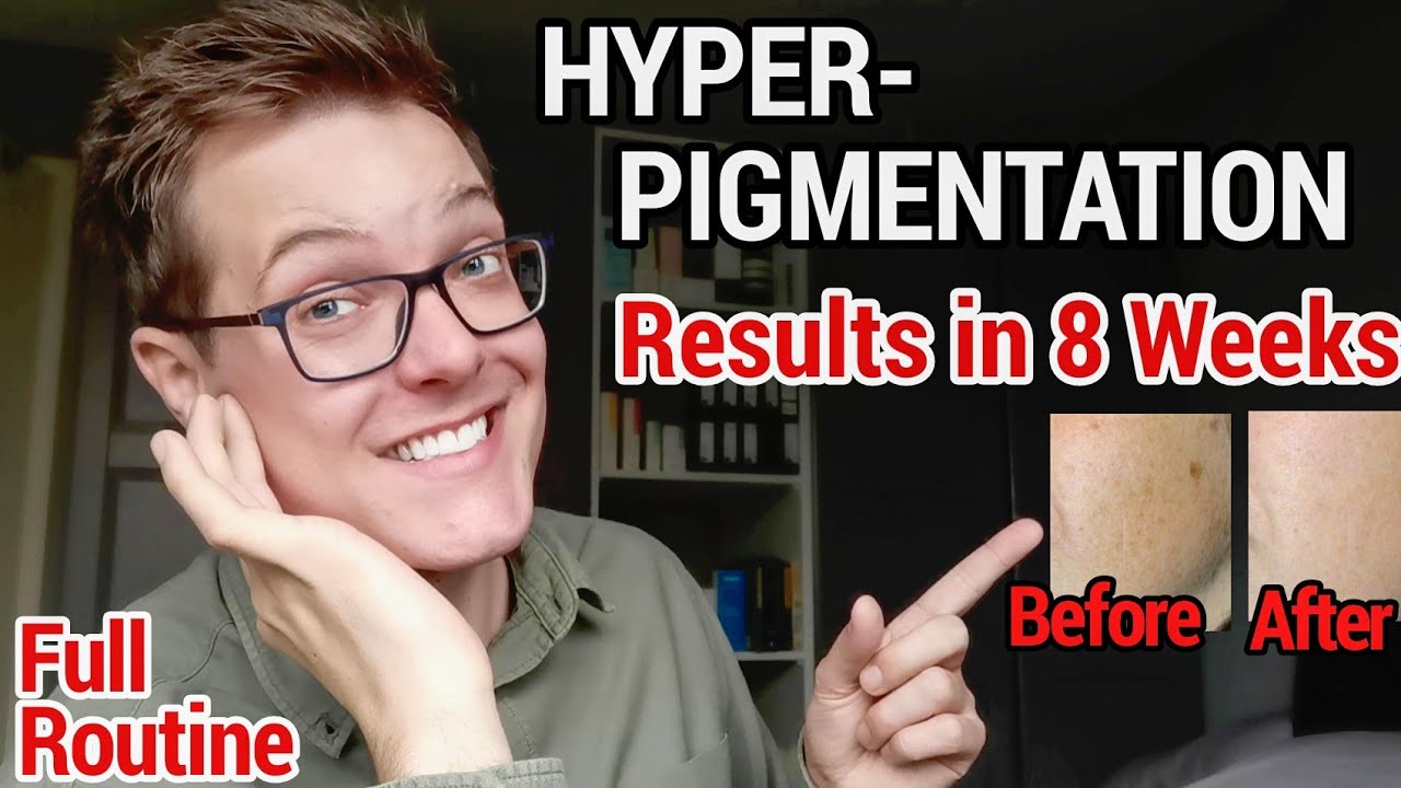 HYPERPIGMENTATION Skincare Routine - Tackle Dark Spots QUICK