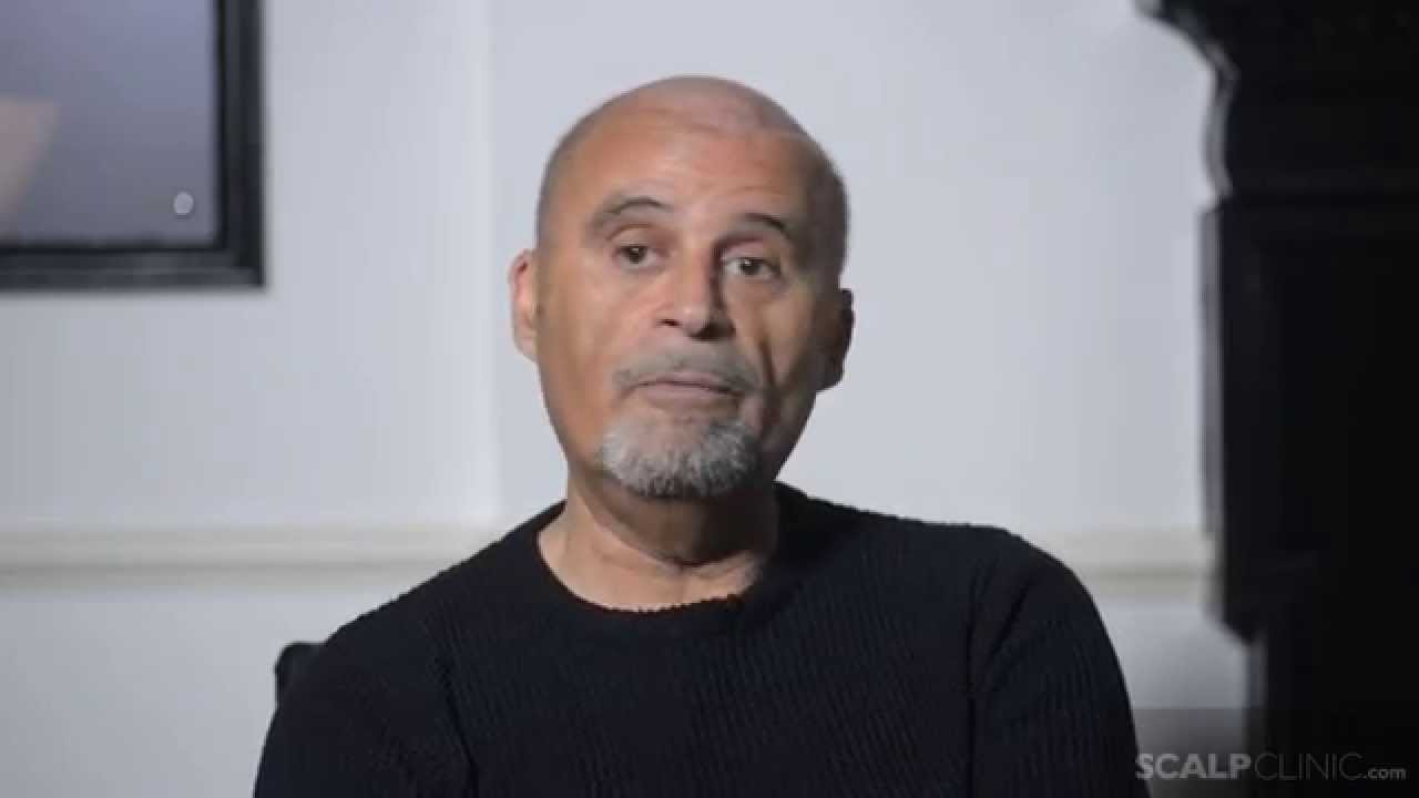 Scalp Micropigmentation at Scalp Clinic -- Nick's Hair Loss Solution 40 Years Later (before)