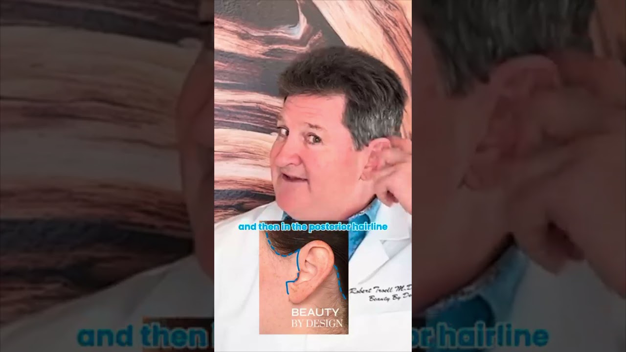 Will there be any scars after a face lift? My findings after 20 years of board-certified practice